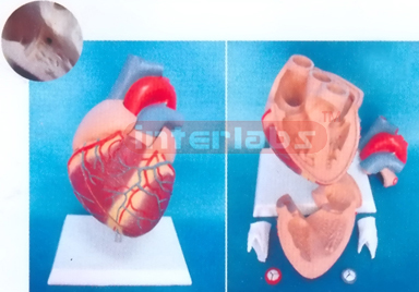 MIDDLE HEART WITH VENTRICULAR SEPTAL DEFECT